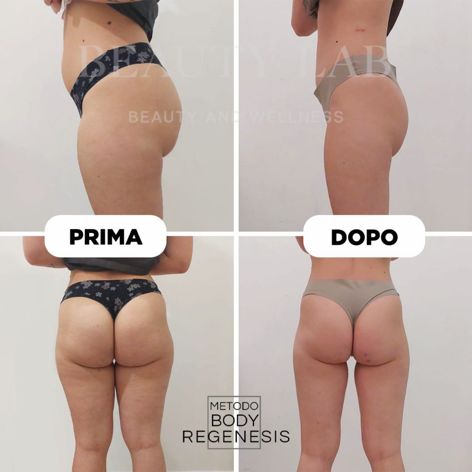 Prima e dopo BODY REGENESIS® — profilo e vista posteriore