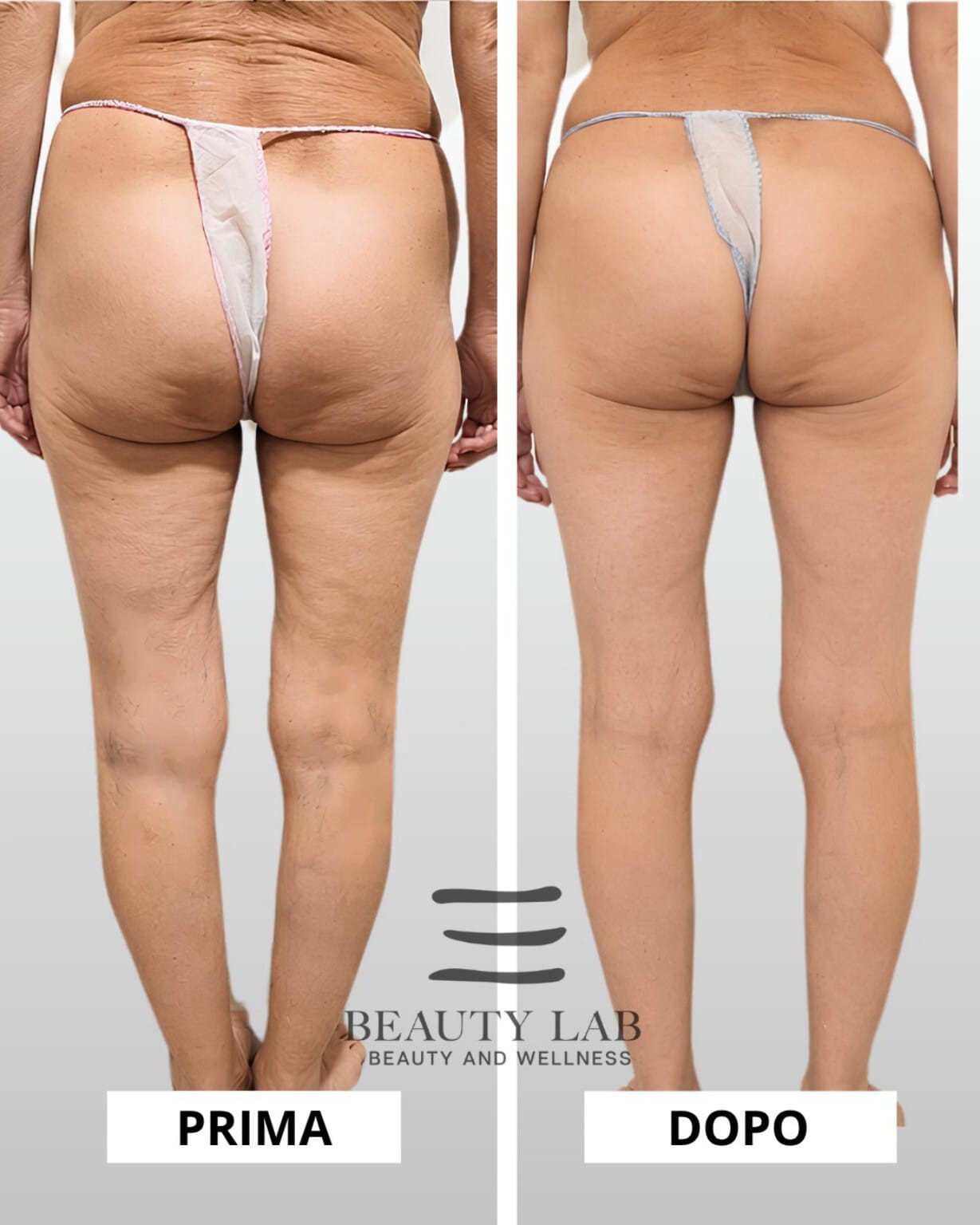 Prima e dopo BODY REGENESIS® — glutei e gambe, vista posteriore