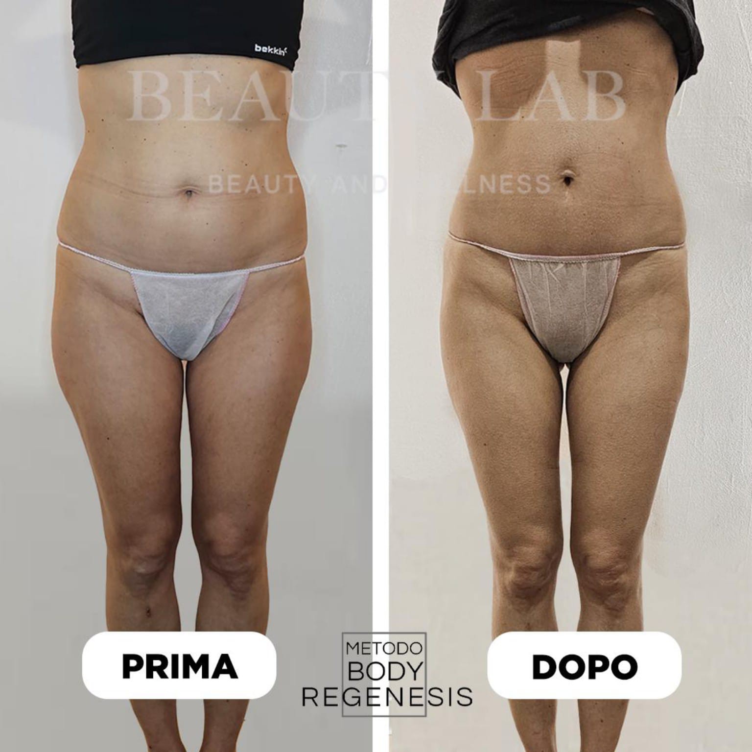 Prima e dopo BODY REGENESIS® — addome e cosce