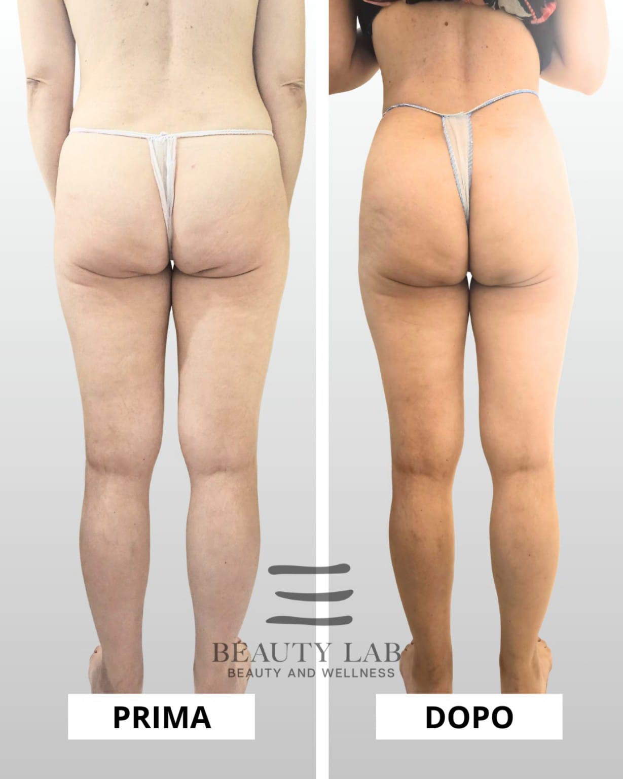 Prima e dopo BODY REGENESIS® — glutei e cosce, vista posteriore