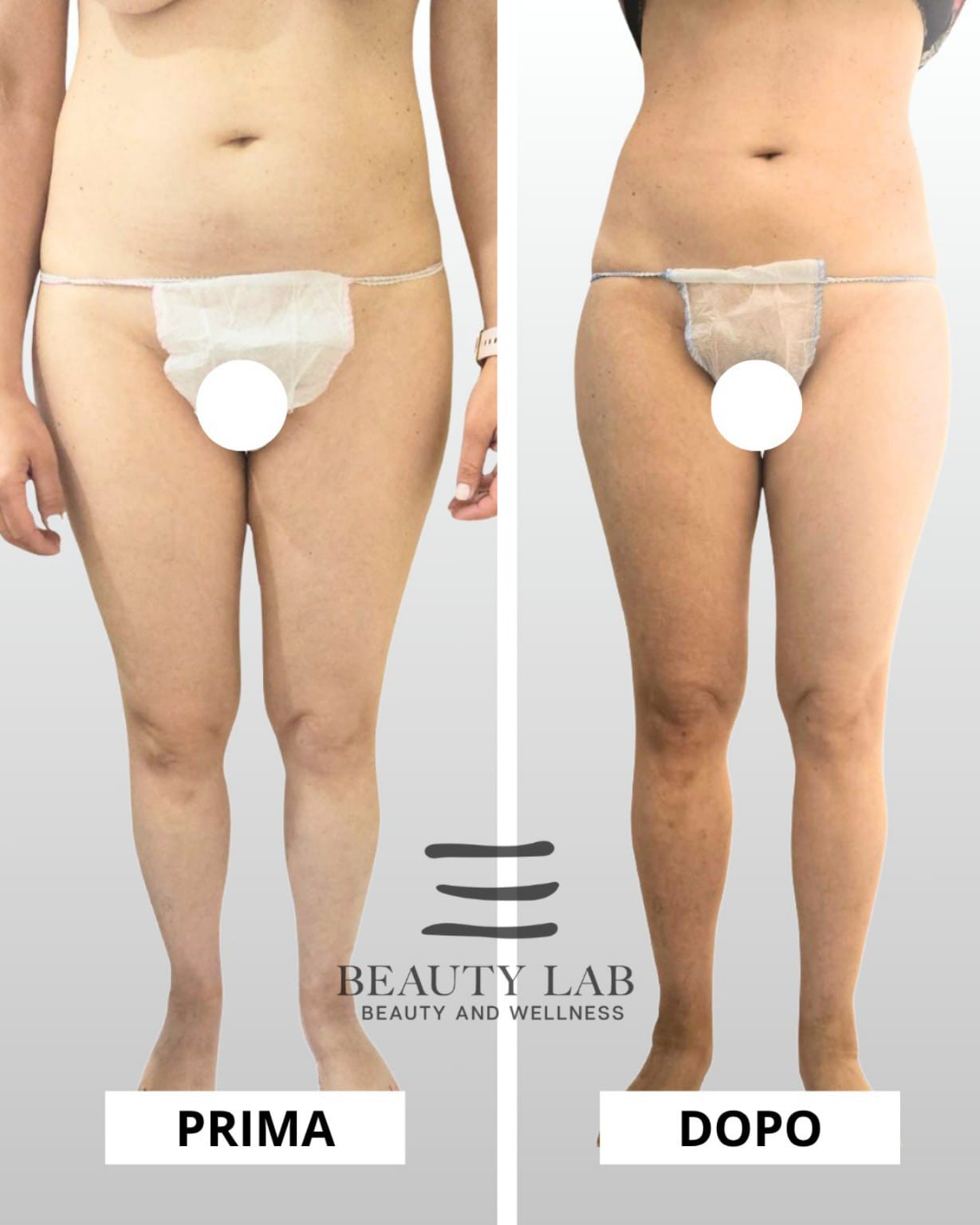 Prima e dopo BODY REGENESIS® — addome e gambe, vista frontale