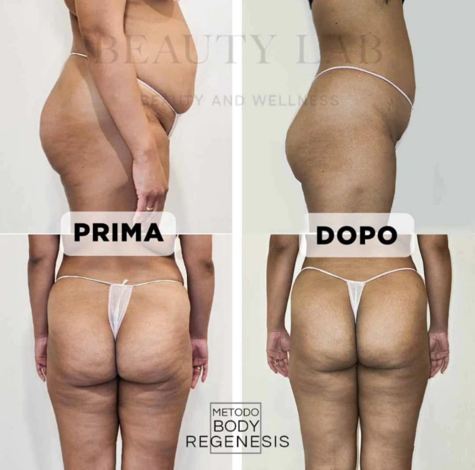 Prima e dopo BODY REGENESIS® — fianchi e glutei
