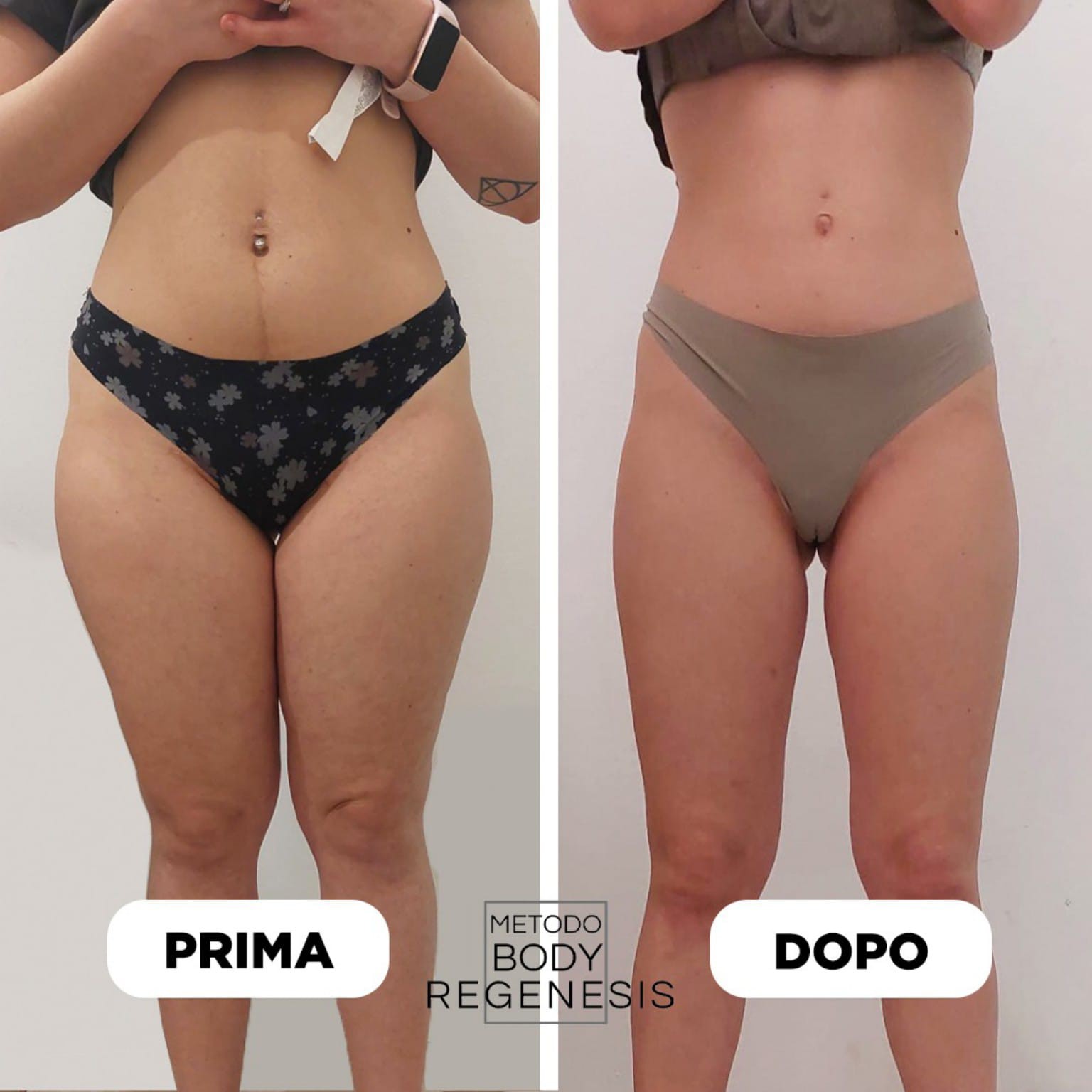 Prima e dopo BODY REGENESIS® — silhouette completa, vista frontale
